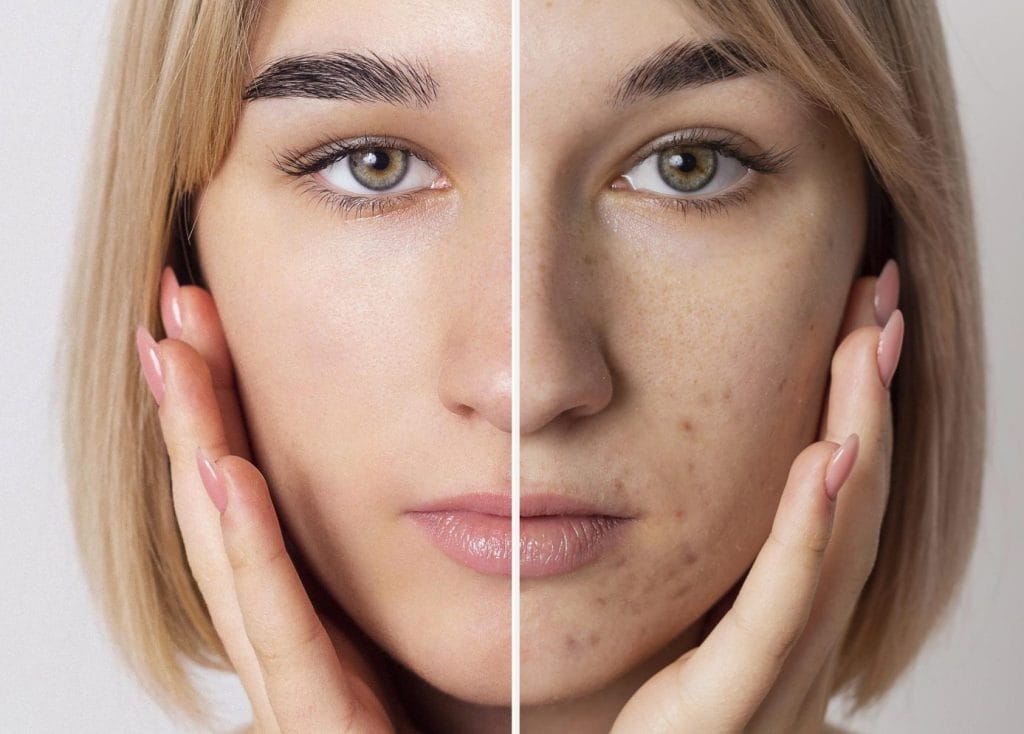 Απαλλαγείτε από την ακμή με ασφαλείς και φυσικές θεραπείες χωρίςΚλείστε ραντεβού σήμερα!