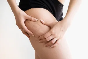 Κυτταρίτιδα – όλα όσα πρέπει να γνωρίζεις: από τις αιτίες & τα στάδια μέχρι πρόληψη. Βελτίωσε την εμφάνιση του δέρματός σου άμεσα!